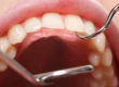 Why Do My Gums Bleed When I Floss? Causes and Treatments