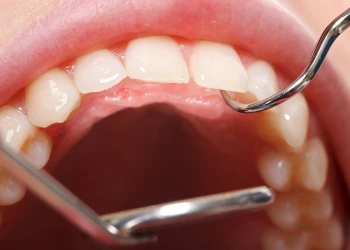 Why Do My Gums Bleed When I Floss? Causes and Treatments