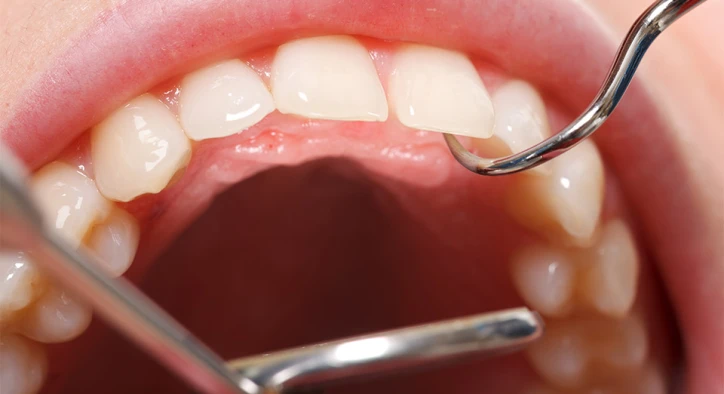 Why Do My Gums Bleed When I Floss? Causes and Treatments