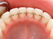 Common Smile Issues with Lower Teeth and How to Fix Them