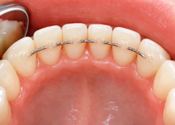 Common Smile Issues with Lower Teeth and How to Fix Them