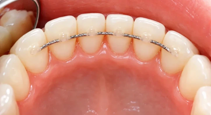 Common Smile Issues with Lower Teeth and How to Fix Them