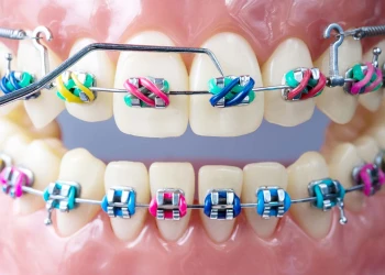 How to Clean Your Retainers: Tips for Maintaining Your Smile