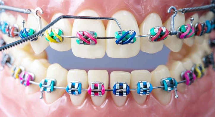 Retainerınızı Nasıl Temizlersiniz: Gülümsemenizi Korumak İçin İpuçları