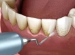 Teeth Scaling: The Importance of Regular Care for Healthy Teeth