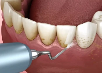 Diş Temizleme (Scaling): Sağlıklı Dişler İçin Düzenli Bakımın Önemi