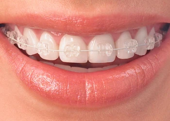 Clip-In Teeth: A Non-Invasive Solution for a Perfect Smile