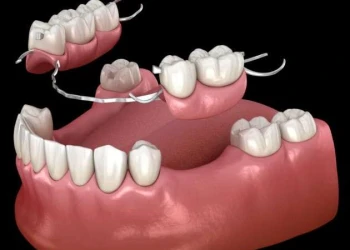 What is a Dental Flipper Code?