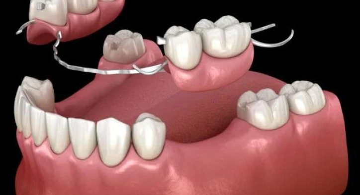 What is a Dental Flipper Code?