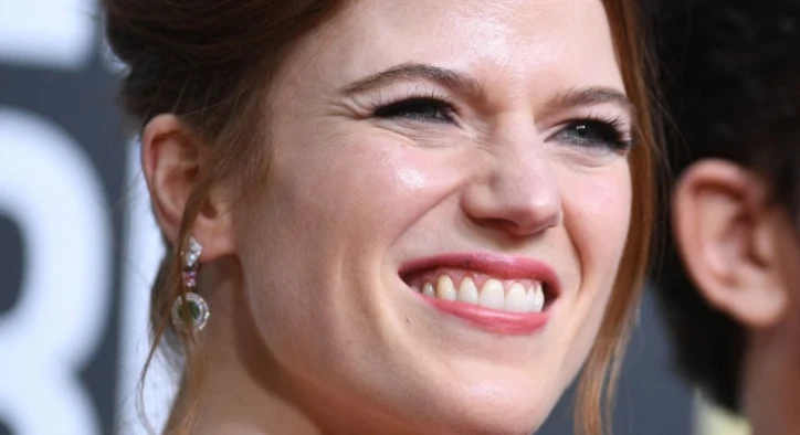Трансформация зубов Rose Leslie – До и После