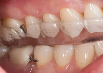 Was ist der Zahnschienen-Code für den Nachtschutz?