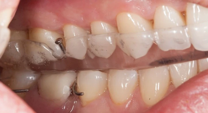 Čo je kód zubnej dlahy pre nočnú ochranu?