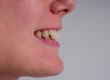 Čo spôsobuje hlboký skus? Ako sa lieči?