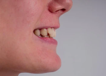 Co způsobuje hluboký skus? Jak se léčí?