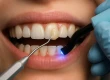 What You Need to Know About Dental Bonding