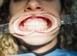 Zahnfleischtransplantation: Verfahren, Vorteile & Kosten 2026
