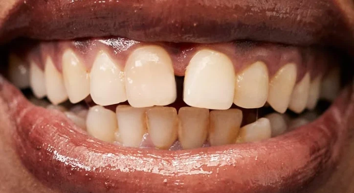 Was verursacht ein Diastema? Wie wird es behandelt?