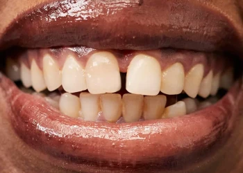 What Causes Diastema? How Is It Treated?