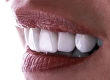 Was sind Emax-Veneers? Wie viel kostet es in der Türkei?