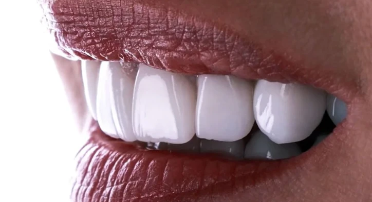 What Are Emax Veneers? How Much Does It Cost In Turkey?