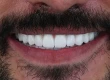 Porcelánové fazety v Turecku: Průvodce transformací úsměvu