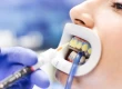 What Is Teeth Bleaching? How Much Does It Cost In Turkey?