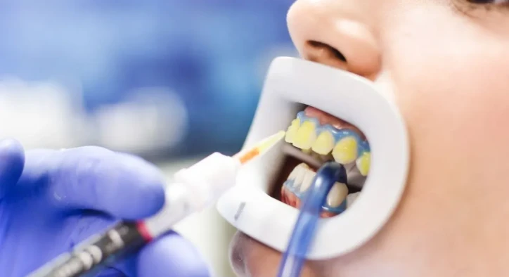 What Is Teeth Bleaching? How Much Does It Cost In Turkey?