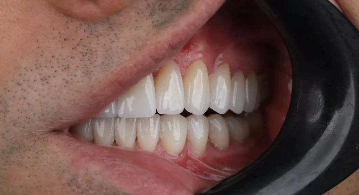 Zirconia Crown Guide Cost, Benefits and Longevity 2026