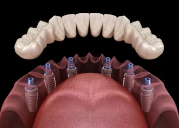 Všetko na 6 zubných implantátoch v Turecku: Ceny a priebeh