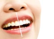 Composite Bonding vs Veneers: Costs, Differences & Lifespan