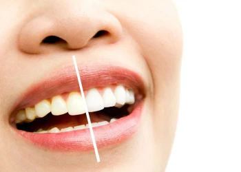 Composite Bonding vs Veneers: Costs, Differences & Lifespan