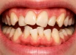 Каковы причины и методы лечения искривления зубов?