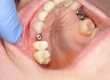 Dental Implant Healing Stages: Timelines, Recovery & Bone Grafting