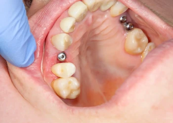Štádiá Hojenia Zubného Implantátu: Časový Harmonogram