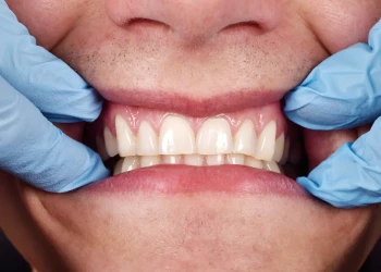 Zahnfleischgesundheit nach Veneers: Pflege & Prophylaxe