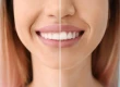 Tooth Shaping Procedure, Safety, Side Effects and Aesthetic Alternatives