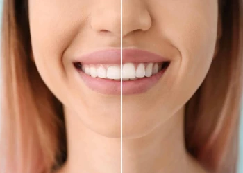 Tooth Shaping Procedure, Safety, Side Effects and Aesthetic Alternatives