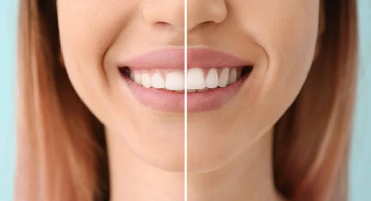 Tooth Shaping Procedure, Safety, Side Effects and Aesthetic Alternatives