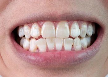 Weiße Flecken auf den Zähnen Ursachen, Vorbeugung und Behandlungsleitfaden