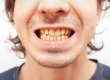 What Causes Yellow Teeth? Can Yellow Teeth Be Whitened?