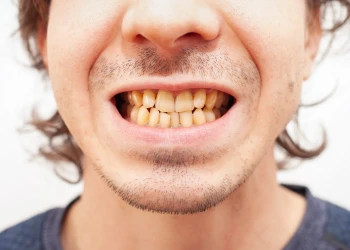What Causes Yellow Teeth? Can Yellow Teeth Be Whitened?
