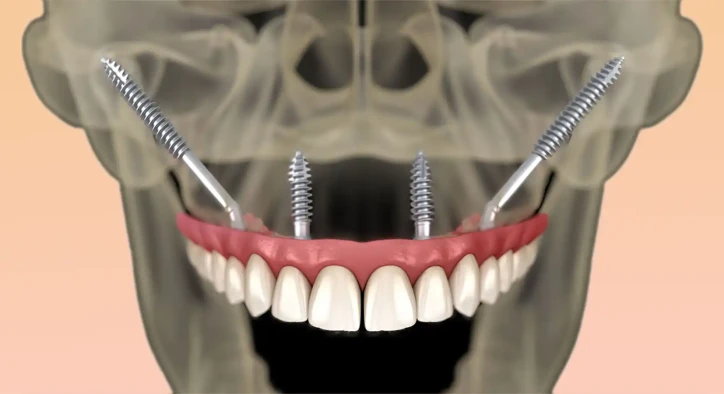 Zygomatische Implantate: Fortschrittliche Vollbogen-Versorgung bei massivem Knochenschwund