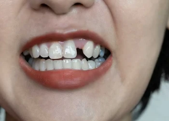 Что такое гиподонтия? Лечение, причины и восстановление