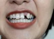Co Je Hypodoncie? Léčba, Příčiny A Náhrady