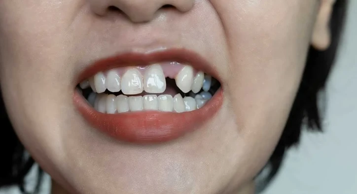 What Is Hypodontia? Treatment, Causes & Restorations