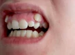 Retinierte Eckzähne: Freilegung, Einordnung, OP & Implantat