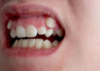 Retinierte Eckzähne: Freilegung, Einordnung, OP & Implantat