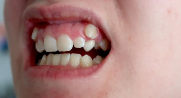 Impacted Canine Teeth: Fix, Surgery, Braces & Adult Options