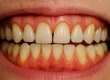 What Is Receding Gums? What Causes It? How Is It Treated?