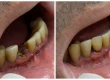 Čo Sú Zubné Implantáty S Okamžitým Zavedením? Postup A Ceny